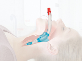 Laryngeal Tube Positioning, Form and design allow an easy insertion and correct position in the hypopharynx.
